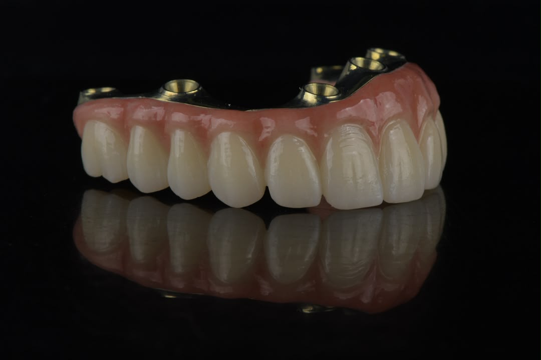 Full-arch restoration on titanium bar — front view