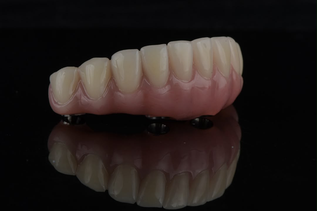 Full-arch restoration with gold bar — front view