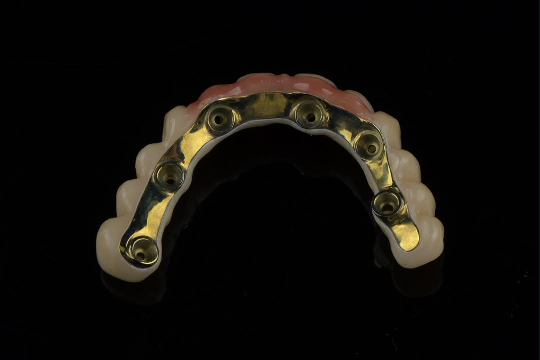 Full-arch restoration with gold bar — intaglio view