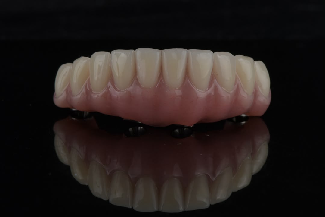 Lower arch prosthesis — front view