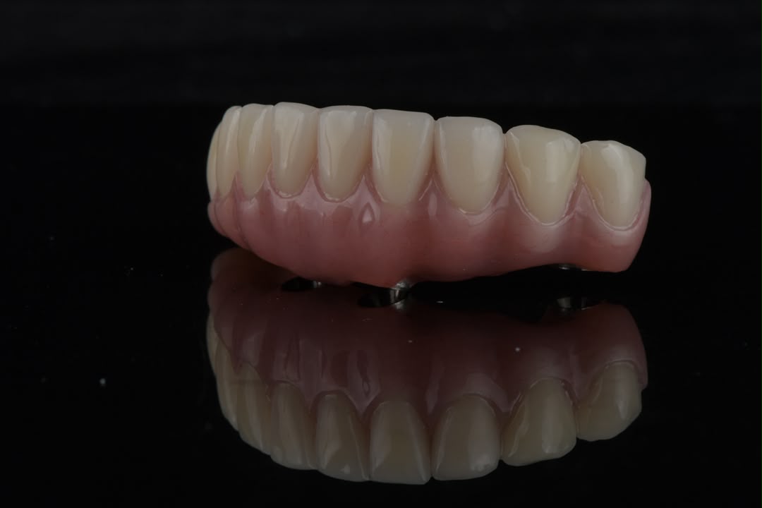 Lower arch prosthesis — palatal view