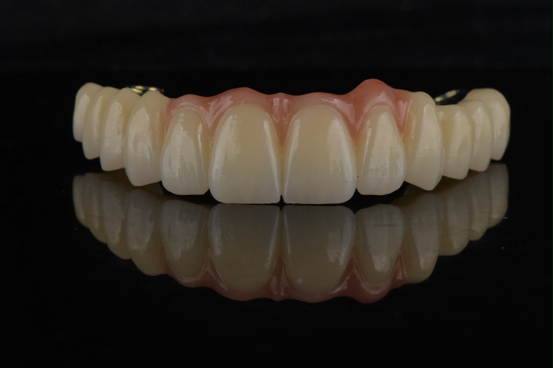 PMMA full-arch prosthesis — front view