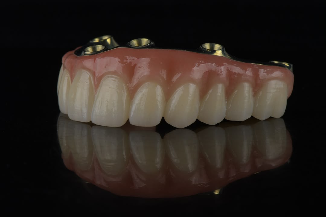 Titanium bar full-arch restoration — front view