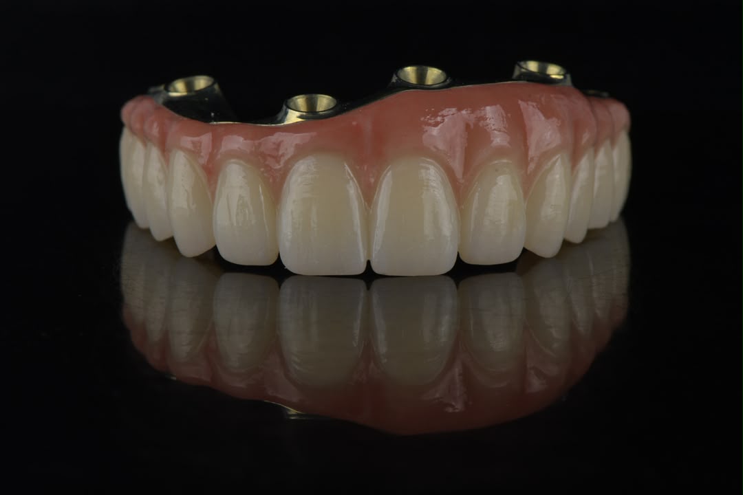 Titanium-reinforced full-arch restoration — front view