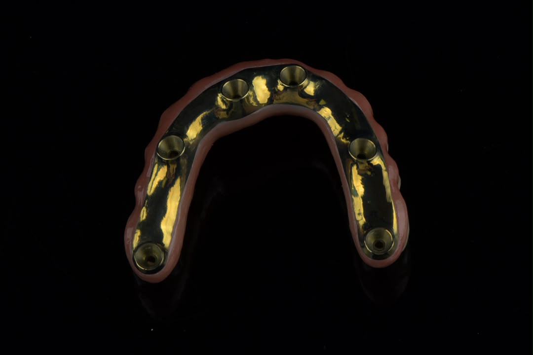 Titanium bar — intaglio view showing implant cylinders